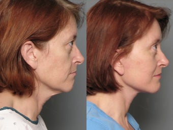 Brow Lift 338739