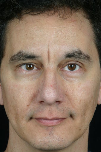 Pearl, Botox and Juvederm to Glabella (between eyes) before 308344