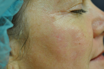 Mole Removal after 622174