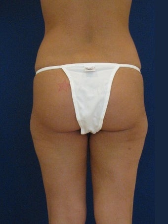 Vaser Hi-Def Liposuction of the back, flanks, medial and lateral thighs before 422739