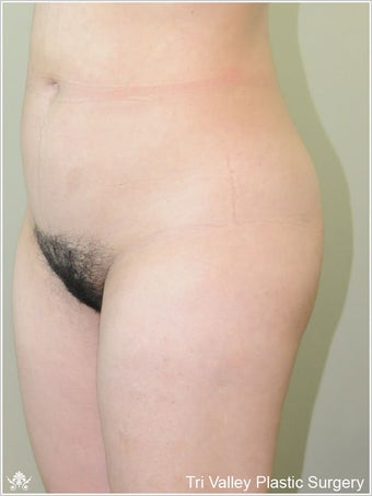 Brazilian Buttock Lift before 420872