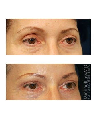Facial Rejuvenation - Brow Lift 395967