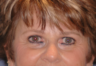 Pretrichial forehead lift and upper blepharoplasty after 377313