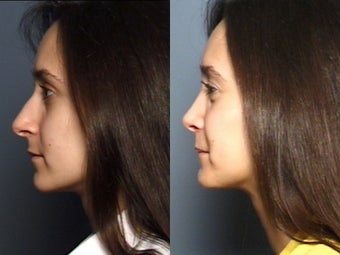 Nose Surgery 338478