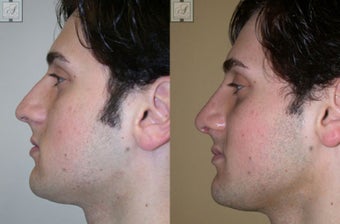 Primary Rhinoplasty before 346246