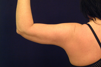 Liposuction 393227