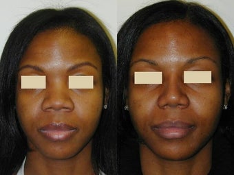 African American Rhinoplasty after 137714