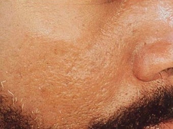 Vbeam for scars after 374584