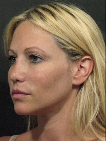 Sculptra after 324803