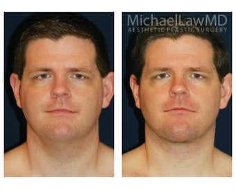 Lower Face and Neck Lift before 395848