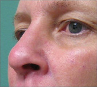 Radiesse on nose after 76996