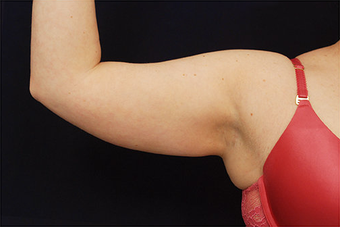 Liposuction 397154