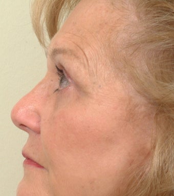 Pearl Laser Treatment after 102778