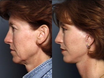 Brow Lift 337413