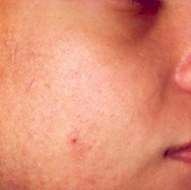 PDT for acne after 376134