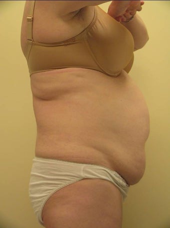 Ultrashape before 234224