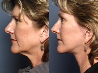 Brow Lift after 338616