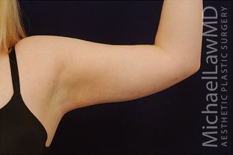 Liposuction after 397154