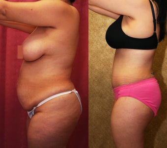 tummy tuck 304704