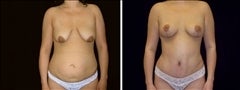 29 year old female, Mommy Makeover before 624676