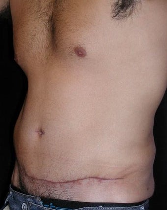 Male tummy Tuck, Flank Liposuction 578169