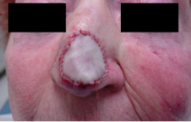 Skin Cancer Surgery on Nose 561062