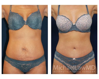 Abdominoplasty - Tummy Tuck before 396068