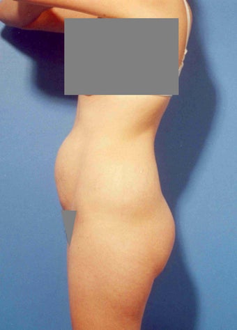 Abdominoplasty before 356332