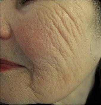 Evolastin- Non Surgical Lift before 498659