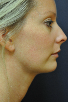 Jawline / Neck Lipo after 624697