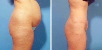 Abdominoplasty before 287034