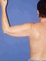 Arm Lift before 356571