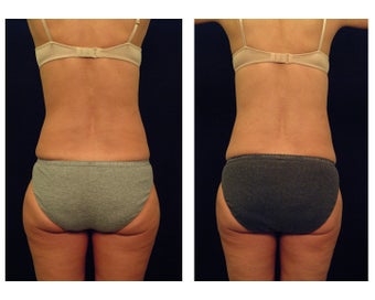 Liposuction after 397032