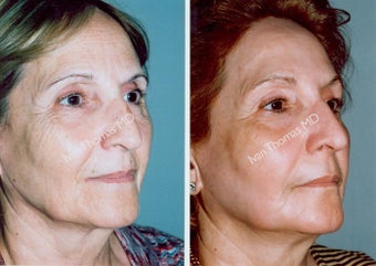 Non-Surgical Face Lift- Exoderm before 243000