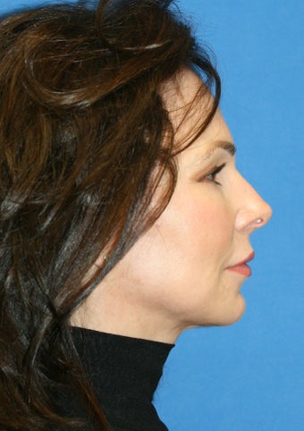 fat transfer after 238754
