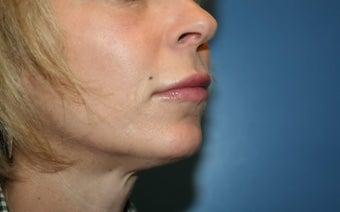 Lip Augmentation after 362762