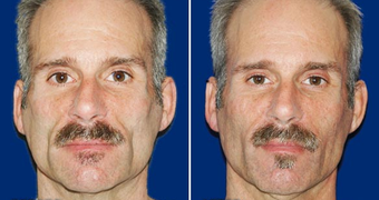 Sculptra before 496294