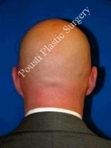 Ear Surgery (Otoplasty) after 616613