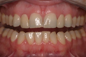 porcelain bridges before 336724