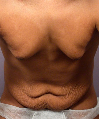 Male Body Contouring before 280188