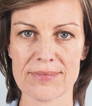 Sculptra before 346262