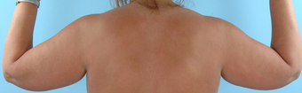 Arm Lift before 230665