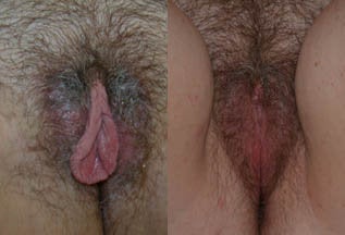 Labiaplasty before 192073