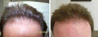 Medical treatment for hair loss (no surgery) before 369178