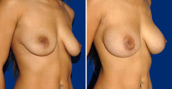 Breast Implants after 494499