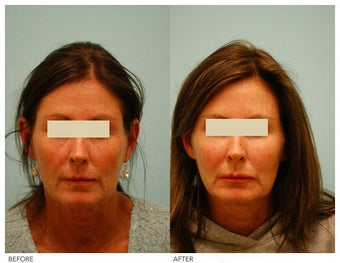 Injectable Fillers (Restylane/Perlane) before 136773
