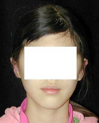 Otoplasty - Ear Surgery after 215189
