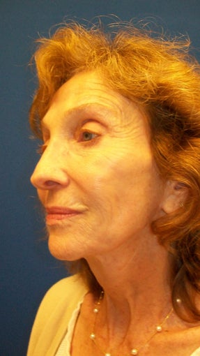 Sculptra 336917