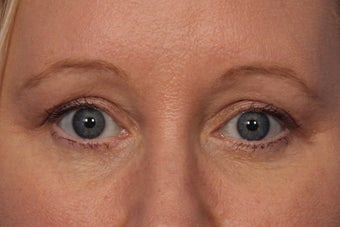 Botox to Crows Feet and Between Eyes (Glabella) before 308334