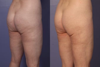 Cellulaze before 607913